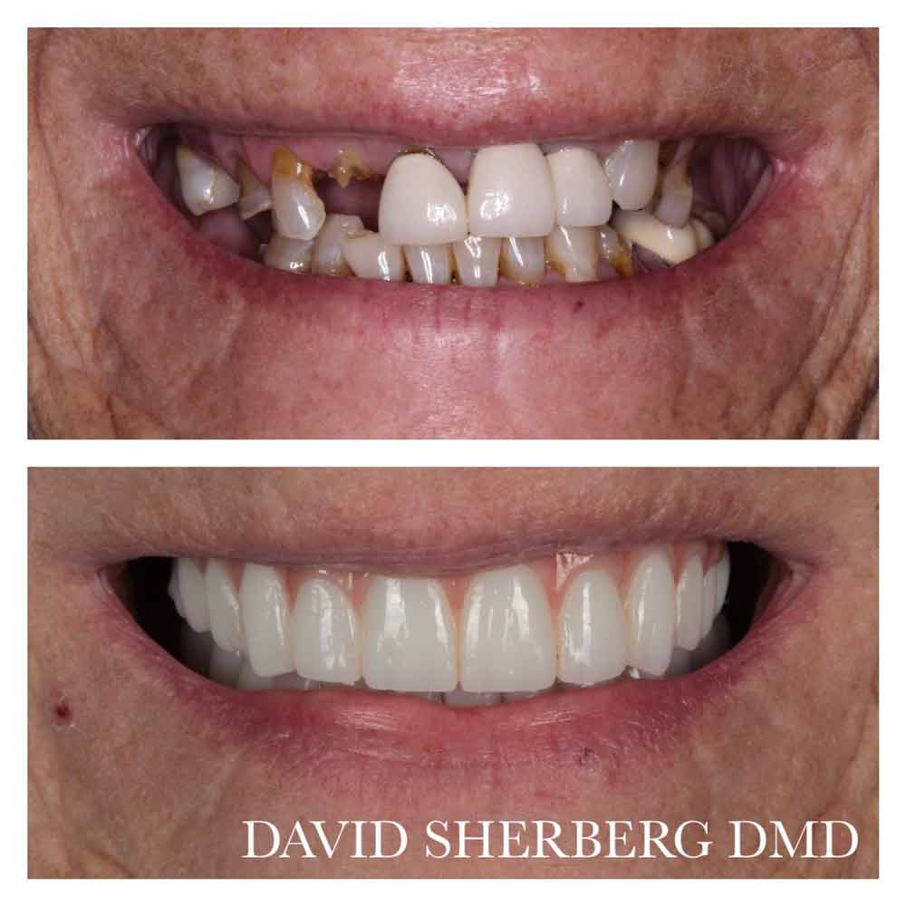 Bayway Dental Patient Kane - Before-and-After