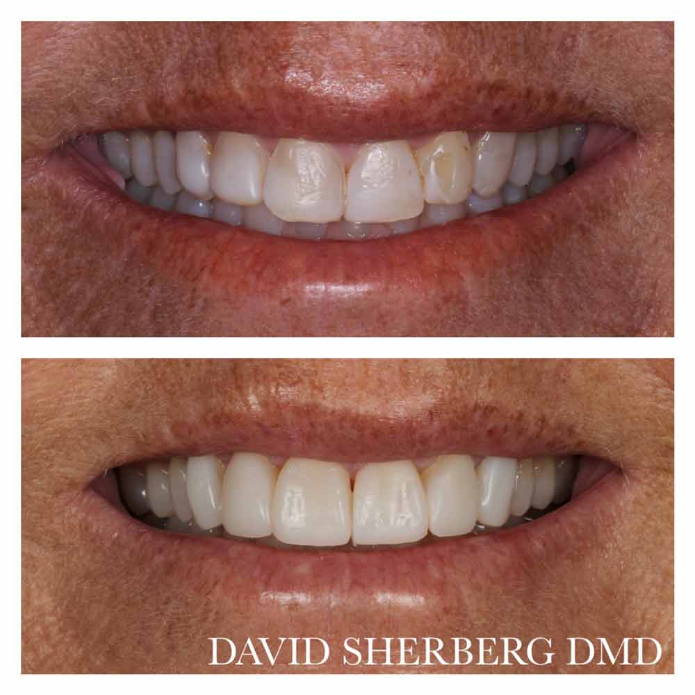 Bayway Dental Patient Kim Craig - Before-and-After