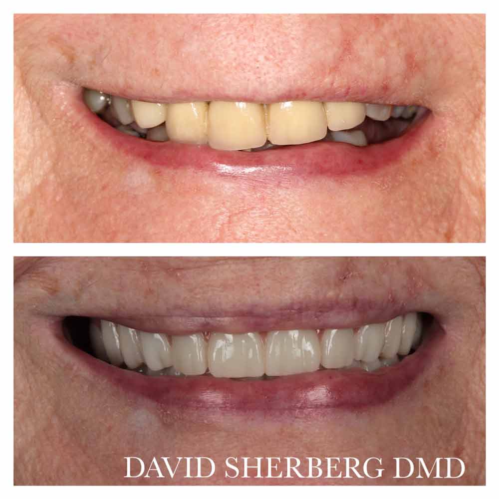 Bayway Dental Patient Scarpetti - Before-and-After