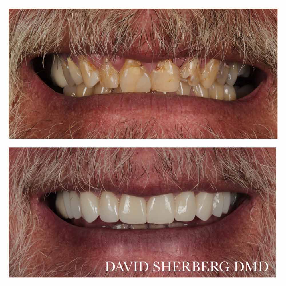 Bayway Dental Patient Genovese - Before-and-After