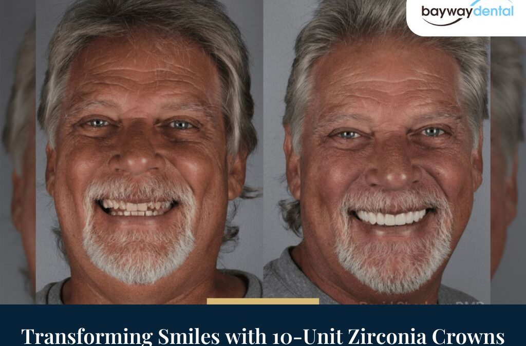 Transforming Smiles with 10-Unit Zirconia Crowns: Case Study