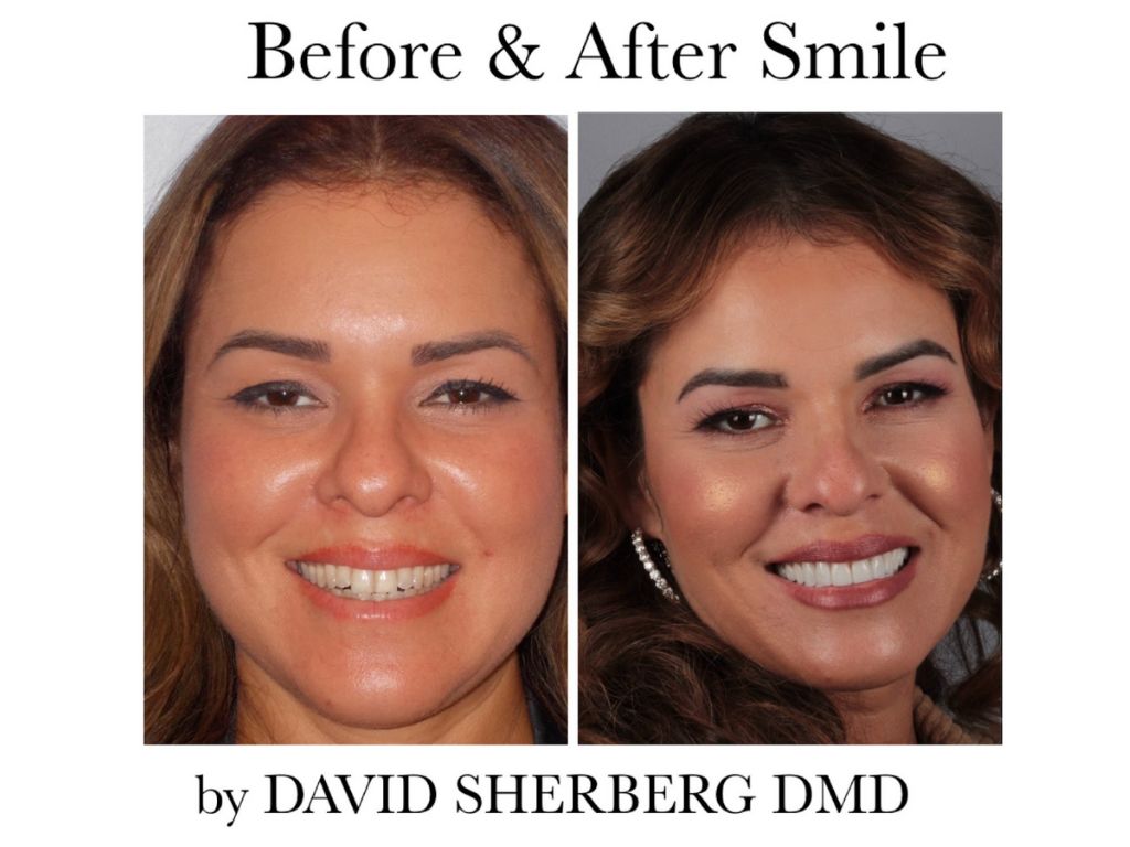 before after smile